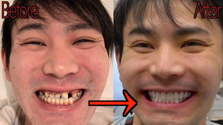 10年間も歯磨きしなかった山ちゃんの歯を600万円かけて治してみた【ドッキリ】